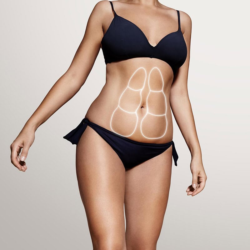 Die Vorteile von CoolSculpting im Vergleich zu anderen Fettentfernungsmethoden